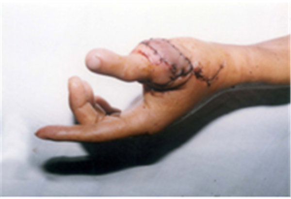 Tái tạo ngón tay từ ngón chân